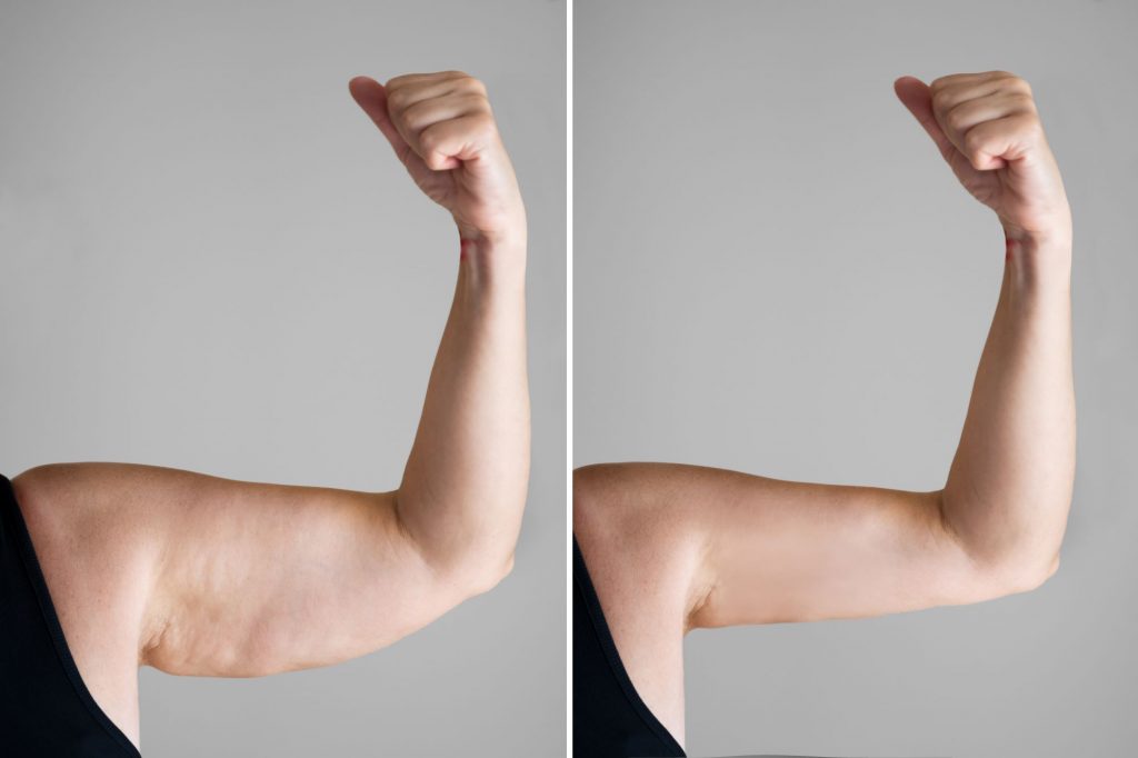 How to Get Rid of Flabby Arms Safely